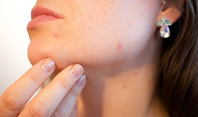 Geçmeyen sivilcenin nedeni araştırılmalı