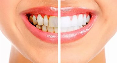 Diş taşı temizliğinin zararı var mı?
