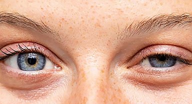 Düşük göz kapağı kaderiniz değil!