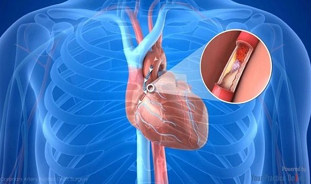Prof. Dr. Nevrez Koylan: Koroner bypass veya stent sonrası